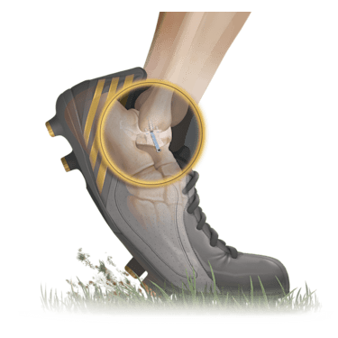 Arthrex - Foot and Ankle Arthrex - Foot and Ankle